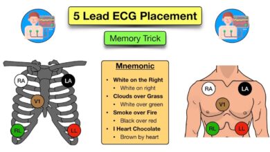 leads ecg placement